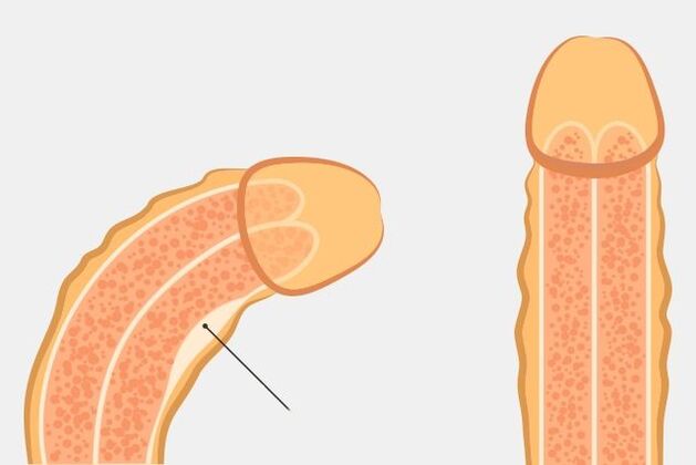 An effective way to fix the penis