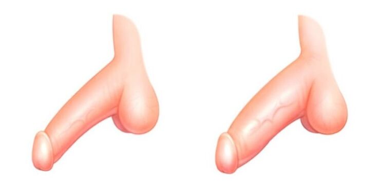 Penis before and after enlargement